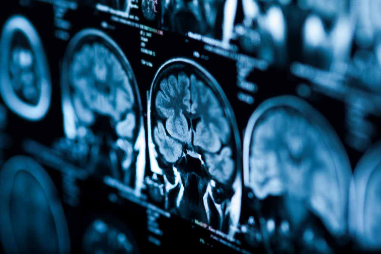 Brain scan