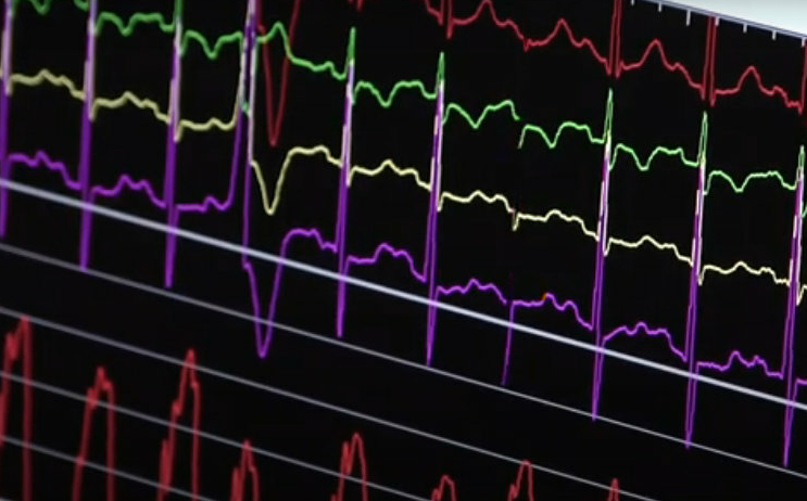 Specialized Neurological Care for Stroke Patients